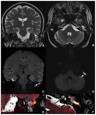 Combining Thin-Section Coronal and Axial Diffusion Weighted Imaging: Good Practice in Middle Ear Cholesteatoma Neuroimaging